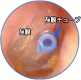 イメージ図：耳に関する疾患