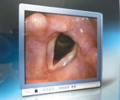 イメージ図：喉の諸疾患